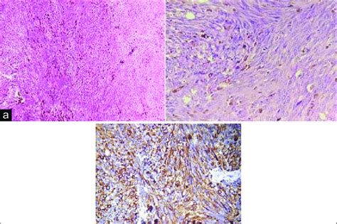 A Histologic Sections Showing Spindle And Plump Cells With Round