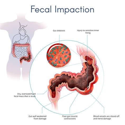 Fecal Impaction: What Is It, Causes, Treatment, And More, 60% OFF