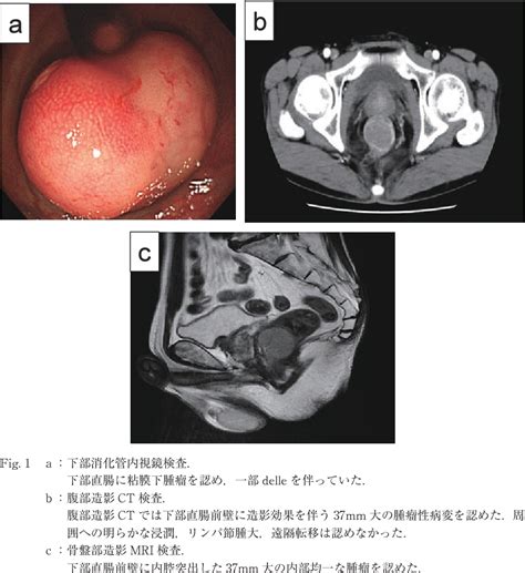 Laparoscopic Inter Sphincteric Resection For Rectal GIST Excreted