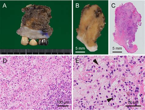 Gross And Histopathological Findings Of The Excisional Biopsy Specimen