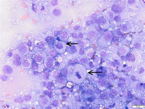 Histiocytic Sarcoma Of The Skin