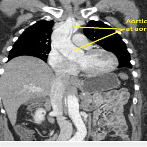 Ct Scan Showing Dissection At Aortic Root Download Scientific Diagram