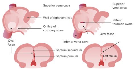 Patent Foramen Ovale Concise Medical Knowledge