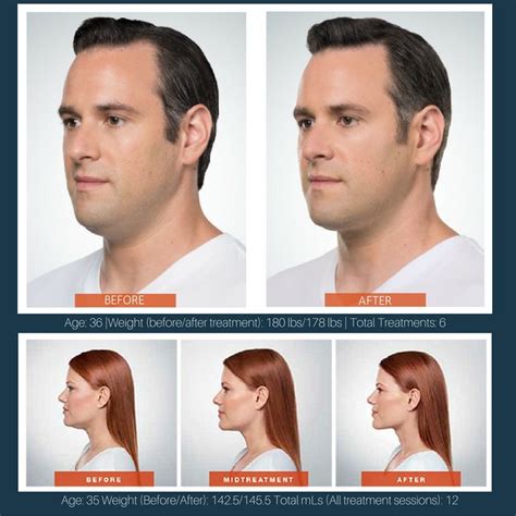 Kybella Your Double Chin Solution No Surgery