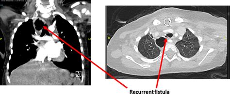 A Ct Scan Demonstrating A Complex Cervical Tracheo Oesophageal Fistula Download Scientific