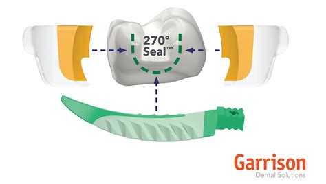 How To Get Rid Of Food Traps Quickly And Easily Clinical Research Dental