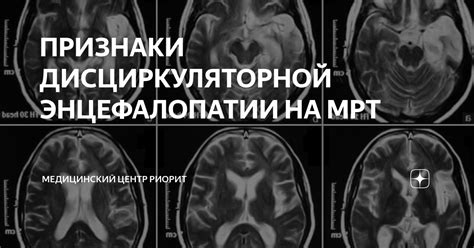 ПРИЗНАКИ ДИСЦИРКУЛЯТОРНОЙ ЭНЦЕФАЛОПАТИИ НА МРТ | Медицинский центр ...