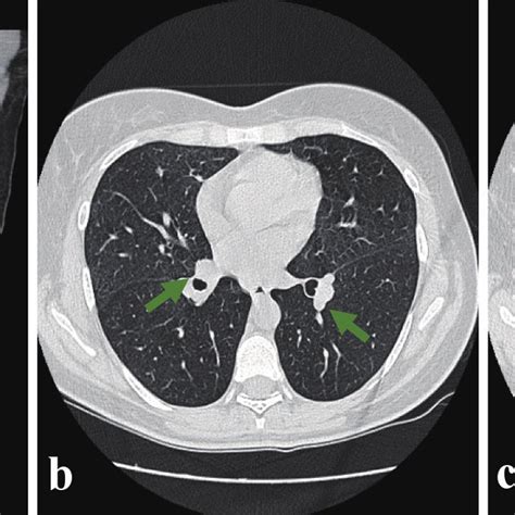 Thoracic CT Scan Showing Multiple Mediastinal Adenopathies In All