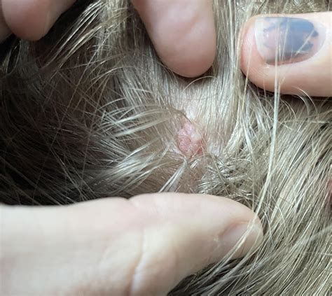 Lump on head : r/DiagnoseMe