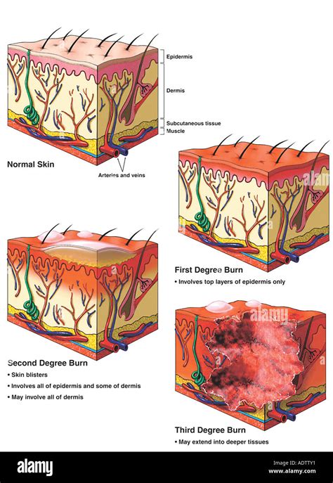 Quemaduras En La Piel Fotograf As E Im Genes De Alta Resoluci N Alamy