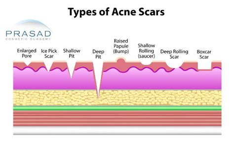 Acne Scars Treatment | NYC and Long Island | Prasad Cosmetic Surgery