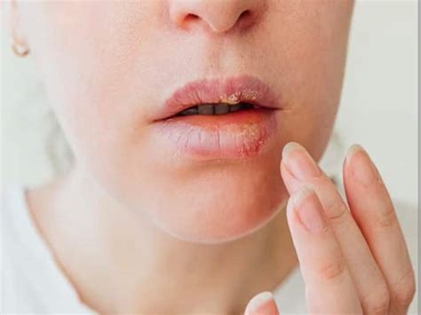 If You Are Sick Of Dry And Cracked Lips Then Know These Reason Behind This अगर आपके भी बार बार