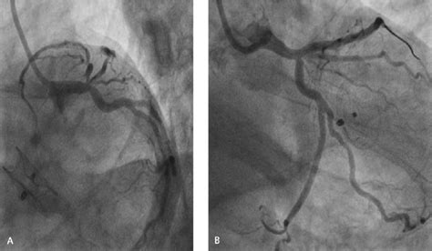 A And B Pre And Post Angioplasty Through The Right Radial Artery