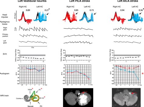 Vestibular Test Comparison Between Vn And Pcs Three Patients With Left Download Scientific