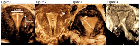 3d Coronal Plane Of The Uterus For Iud Placement A Game Changer