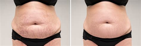 Stretch Mark Removal Beauty Within