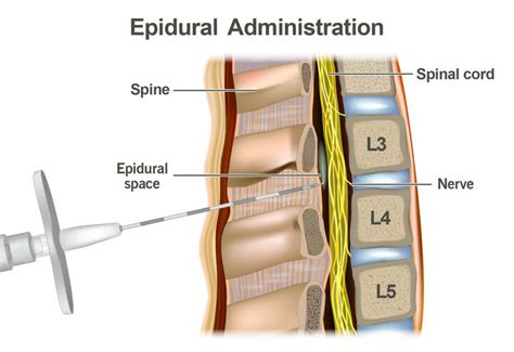 Epidural Anesthesia Complications