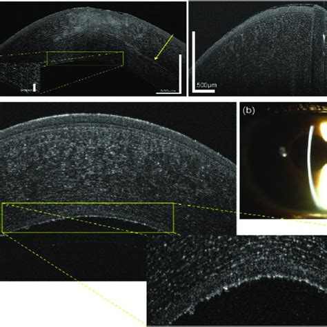 Pdf Anterior Segment Optical Coherence Tomography