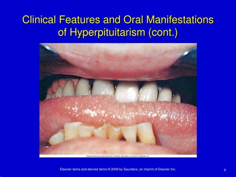 PPT Chapter 9 Oral Manifestations Of Systemic Diseases PowerPoint