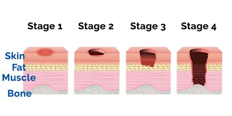 Deep_Tissue_Injury_Stages - Boehringer Labs