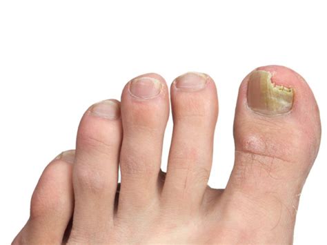 Nail Abnormalities | McLean & Woodbridge VA