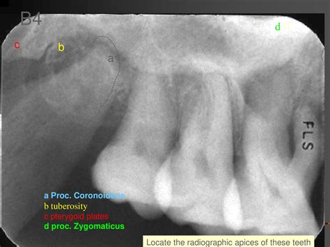 Pterygoid Plate Radiograph