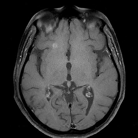 Multiple Sclerosis And Left Optic Neuritis Image Radiopaedia Org