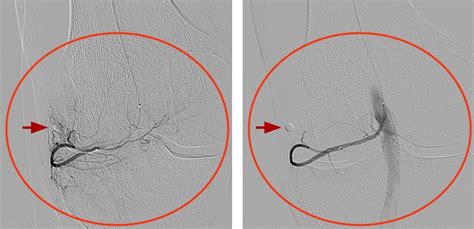 Genicular Artery Embolization Center For Advanced Cardiac And