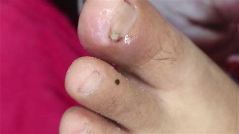 Ep2960 Ingrown Toenail Removal 👣 ออกมาแบบง่าย ๆ 😷 This Clip Is From