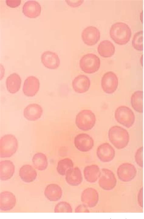 Figure 1 From A Case Of Gray Platelet Syndrome Semantic Scholar