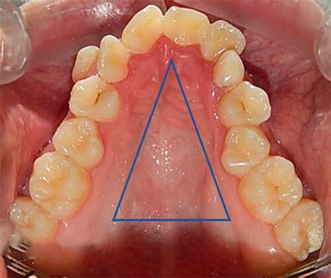 Disyuntor Dental La Soluci N A Problemas Seos Y De Mand Bula En Ni Os