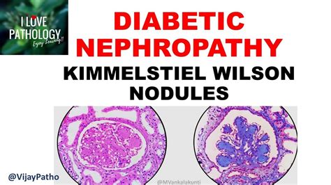 DIABETIC NEPHROPATHY :Pathophysiology & Morphology - YouTube