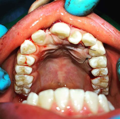 Supernumerary Teeth And Retained Primary Teeth