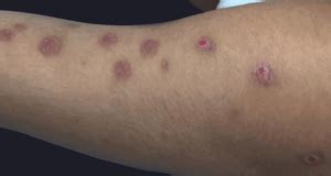 What Do Autoimmune Rashes Look Like? | PrimeHealth Denver