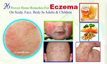 26 Proven Home Remedies For Eczema On Scalp In Adults & Kids