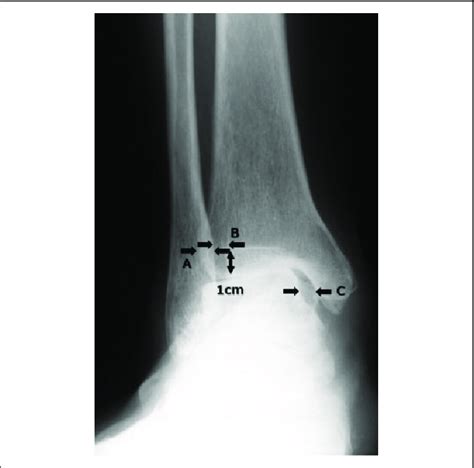 Three Radiographic Parameters Have Been Used In The Diagnosis Of