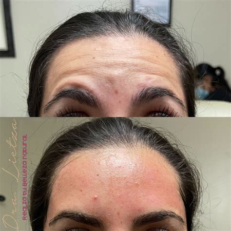 Resultados De Botox Fotos Antes Y Después Dra Lietza Salud Y Belleza