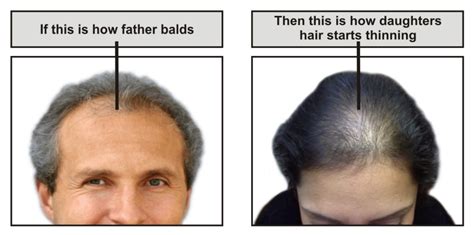 Types Of Hair Loss And Hair Fall Men And Women Baldness