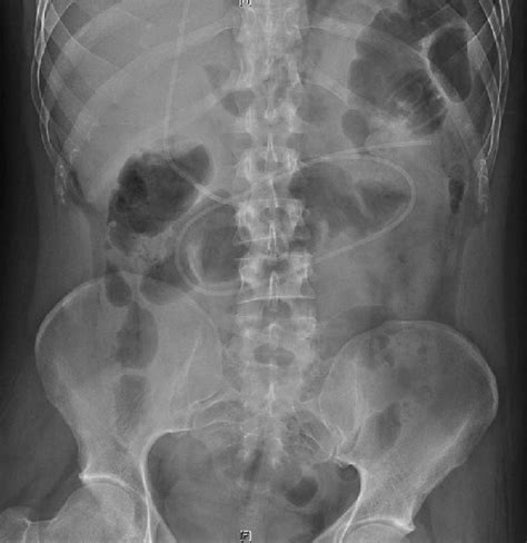 Postoperative Abdominal X Ray Film Following The Patients Second Shunt