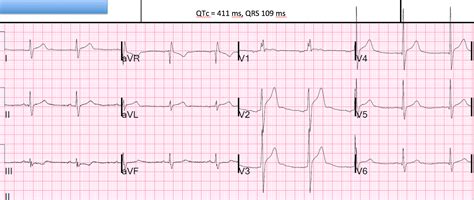 Dr Smiths Ecg Blog Early Repolarization Anterior Mi Or Other