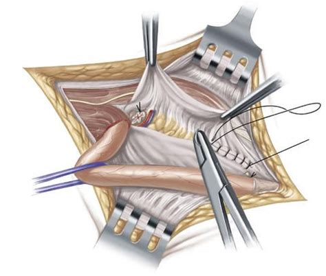 Leistenbruch Op Spezialisten Finden Leading Medicine Guide