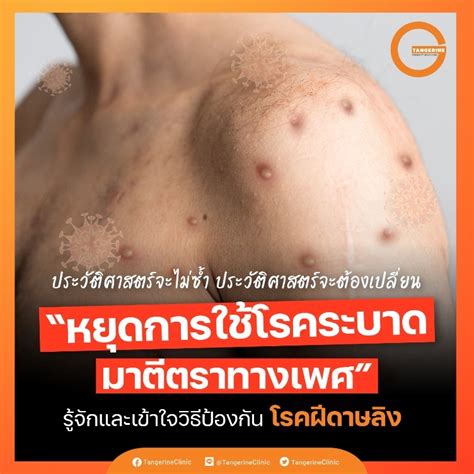 รู้จักและเข้าใจวิธีการป้องกันโรคฝีดาษลิง หยุดการใช้โรคระบาดมาตีตราทาง