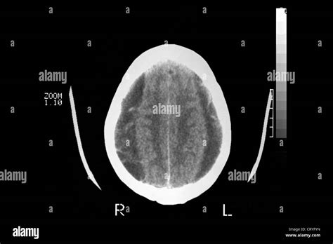 Nmr Brain Scan Hi Res Stock Photography And Images Alamy