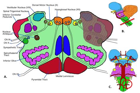 Full Text Brainstem Vascular Syndromes A Practical Guide For Medical