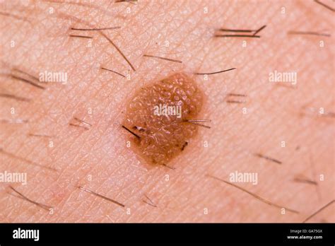 Queratosis Seborreica De La Piel Fotograf As E Im Genes De Alta