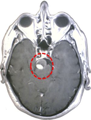 Generalidades Aneurismas Clínica Neuros Neurocirujano Valencia