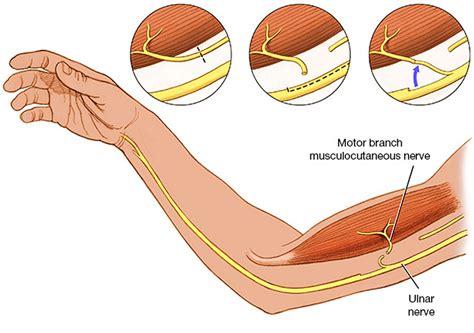 Erb's palsy causes, symptoms, diagnosis, prognosis & Erb's palsy treatment