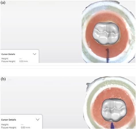 Fracture Resistance Evaluation Of Cadcam Zirconia And Composite