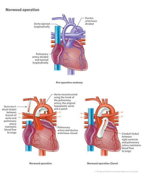 The X Man Our Journey With Hlhs Hypoplastic Left Heart Syndrome