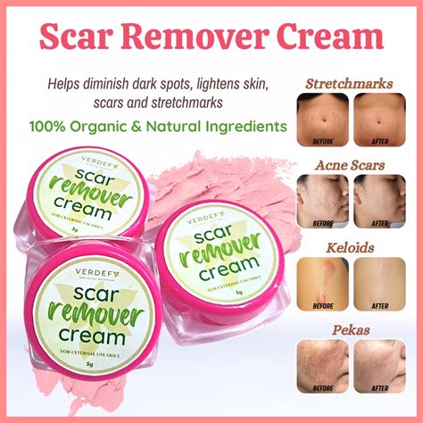 Verdefy Scar Remover Cream Age Of Beauty Ph